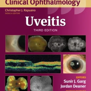 Uveitis